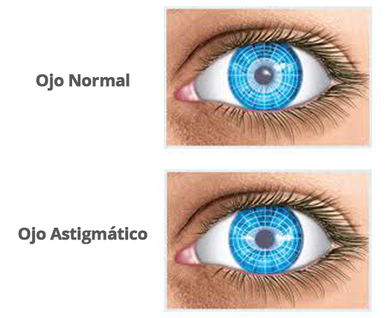 astigmatismo