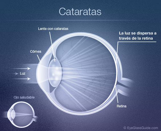 catarata