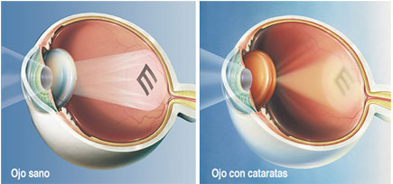 catarata