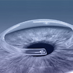 anillos intracorneales