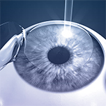 lasik