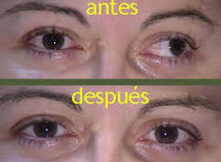estrabismo