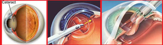 facoemulsificacion