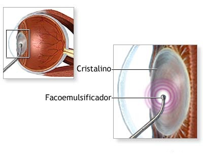 facoemulsificacion