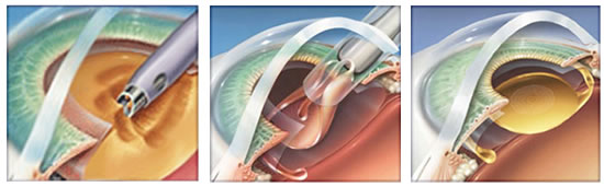 facoemulsificacion