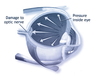 glaucoma