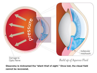 glaucoma