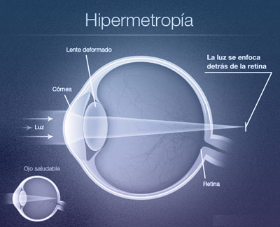 hipermetropia