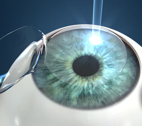 lasik