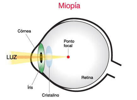 miopia