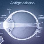 astigmatismo
