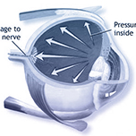 glaucoma