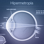 hipermetropia
