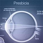 presbicia