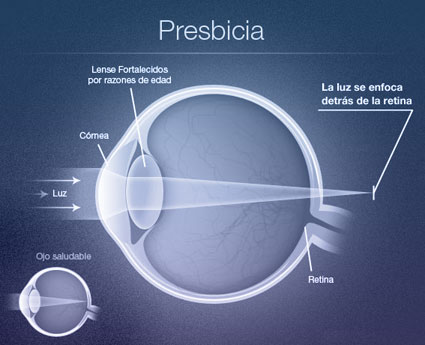 presbicia